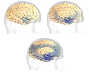 ALZEIHMERS DISEASE AND DEMENTIA