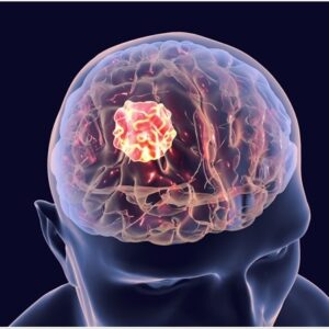 brain tumor-2