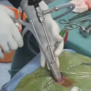 Spine Surgery in Snaayu