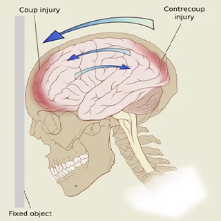 Brain Spine Injury Recovery in Snaayu